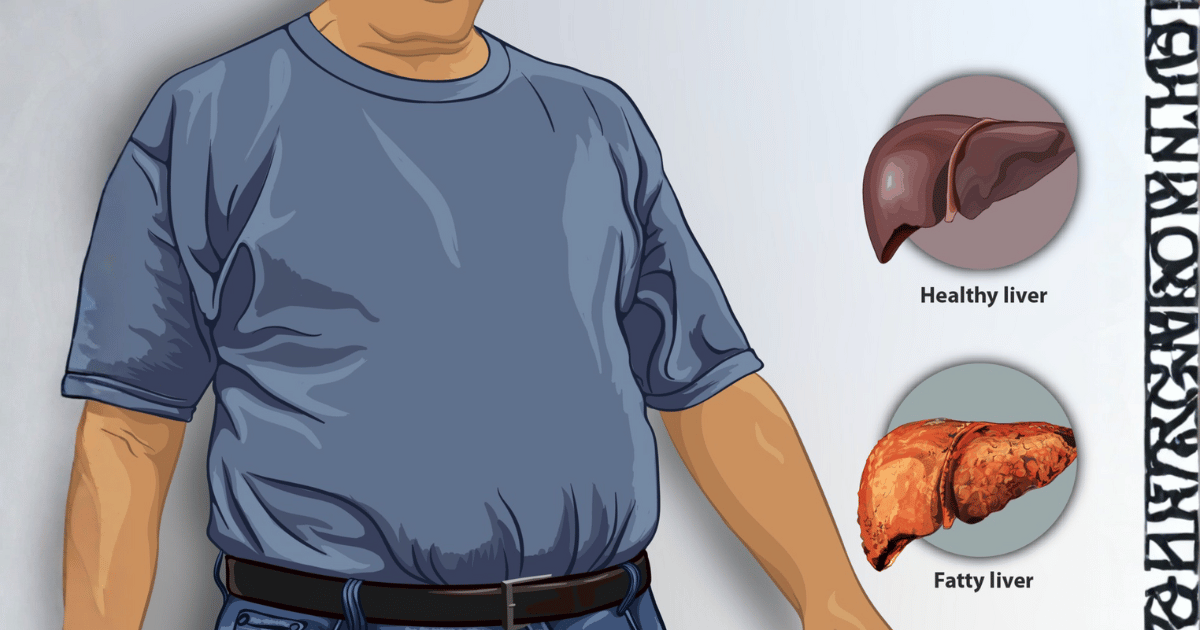 Dieta per il fegato grasso