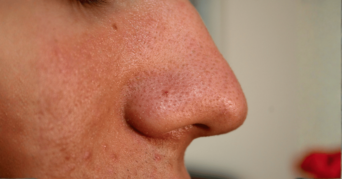 Punti neri: come il metodo dell’asciugamano caldo aiuta a liberare i pori in modo semplice ed efficace.